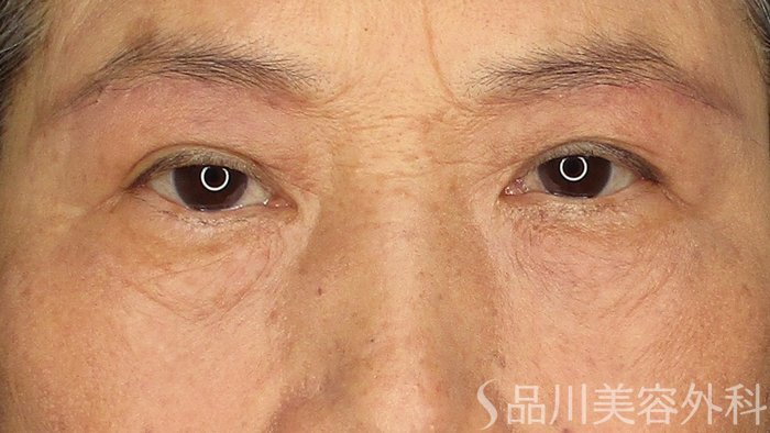 症例NO.70871のAFTER写真