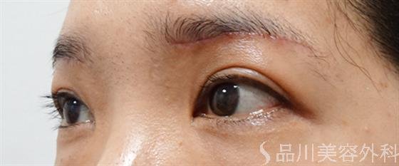 症例NO.52516のAFTER写真