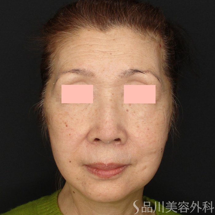 症例NO.73026のAFTER写真