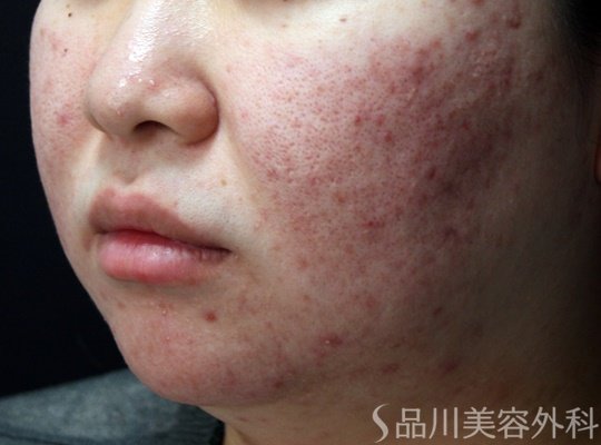 症例NO.70259のBEFORE写真