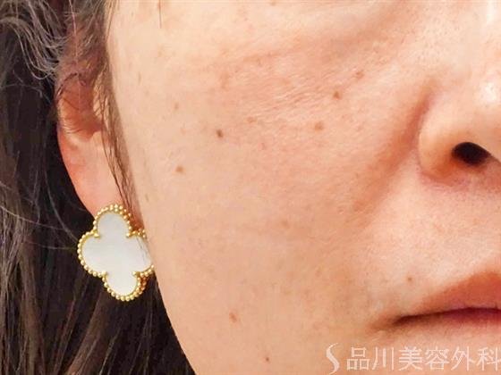 症例NO.55773のBEFORE写真