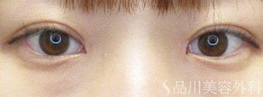 症例NO.65714のAFTER写真