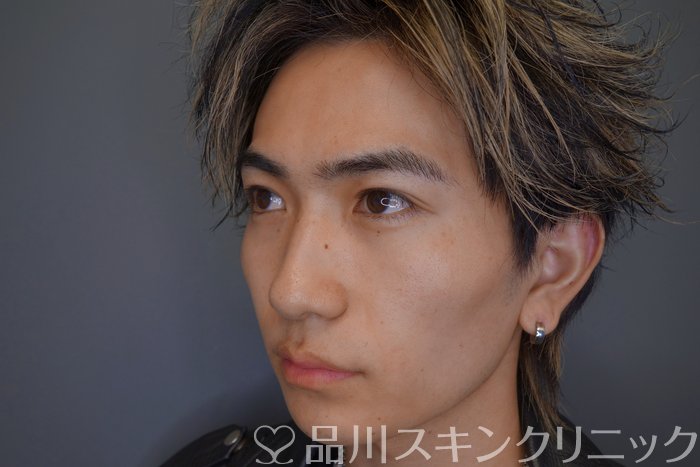 症例NO.73977のAFTER写真