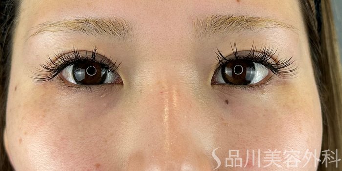 症例NO.70180のBEFORE写真