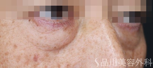 症例NO.72041のBEFORE写真