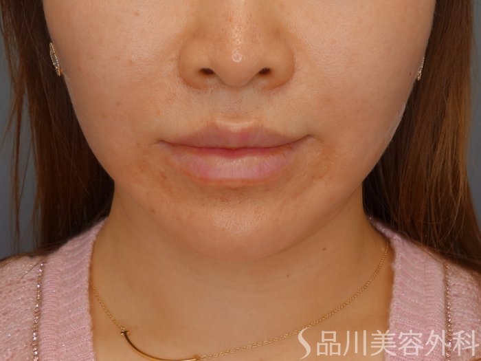 症例NO.72802のAFTER写真