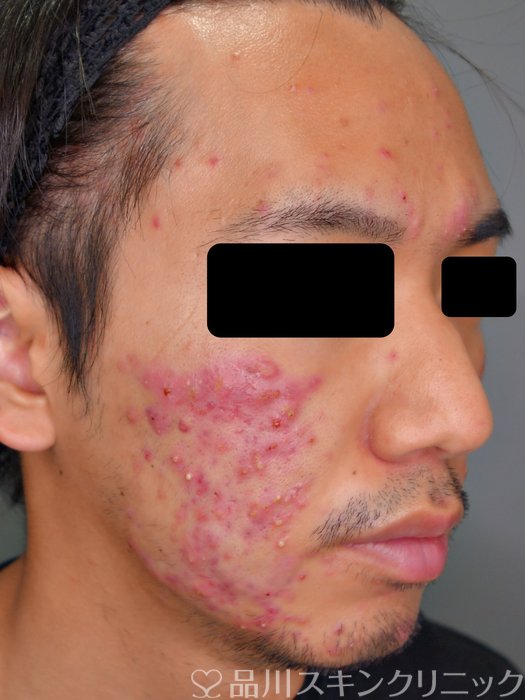 症例NO.73214のBEFORE写真