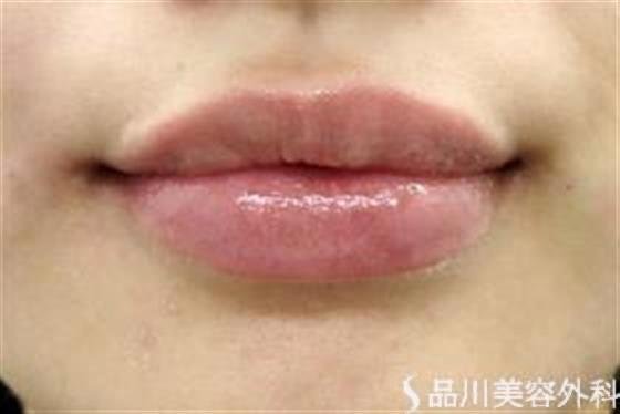 症例NO.35313のAFTER写真