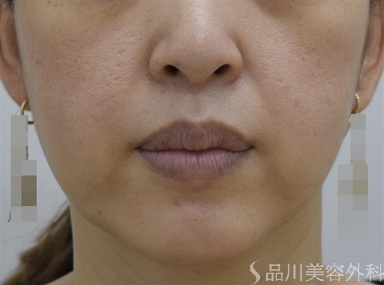 症例NO.44934のBEFORE写真