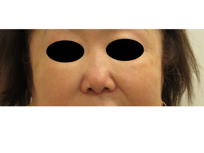 症例NO.75096のBEFORE写真