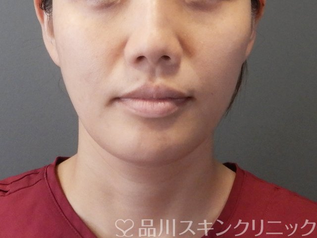 症例NO.65894のBEFORE写真