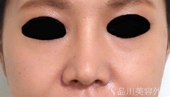 症例NO.31659のAFTER写真
