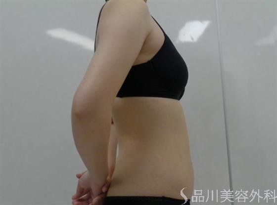 症例NO.34711のAFTER写真