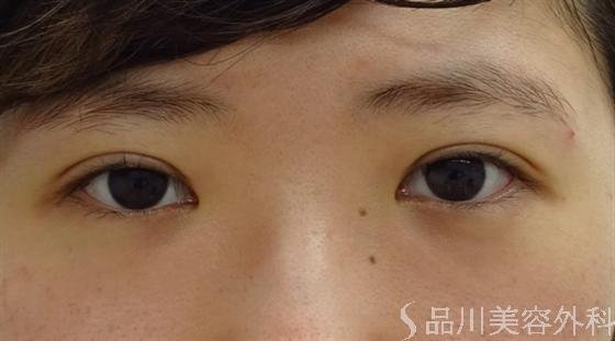 症例NO.16018のAFTER写真