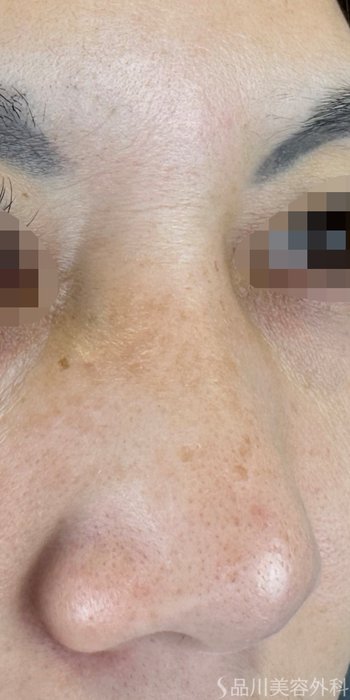 症例NO.65652のBEFORE写真