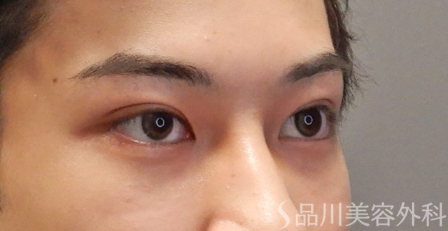 症例NO.74603のAFTER写真