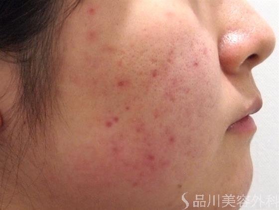 症例NO.23266のBEFORE写真