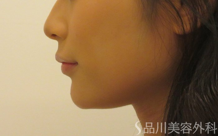 症例NO.71689のAFTER写真