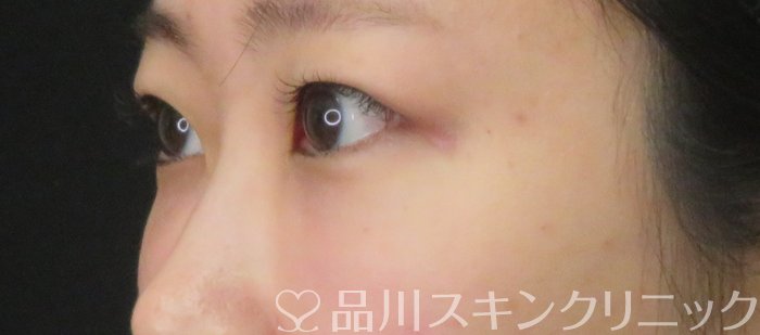 症例NO.74860のAFTER写真