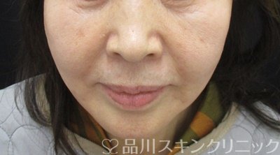 症例NO.65036のAFTER写真