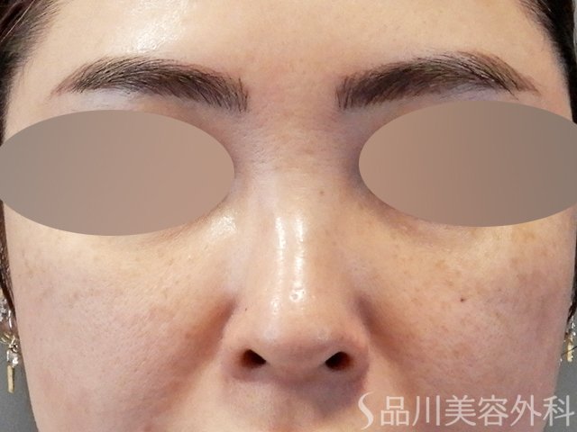 症例NO.67609のBEFORE写真