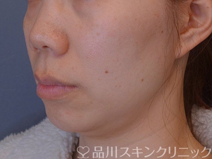 症例NO.74578のBEFORE写真