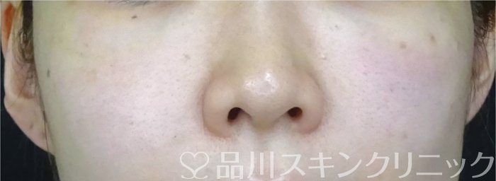 症例NO.72890のAFTER写真