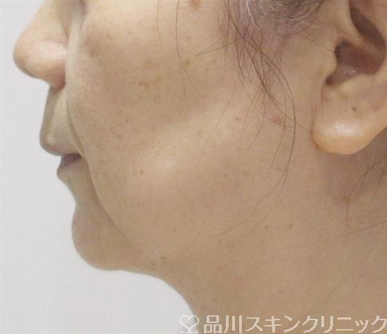 症例NO.36794のBEFORE写真