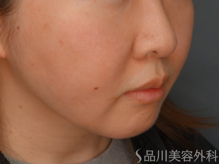 症例NO.73744のAFTER写真