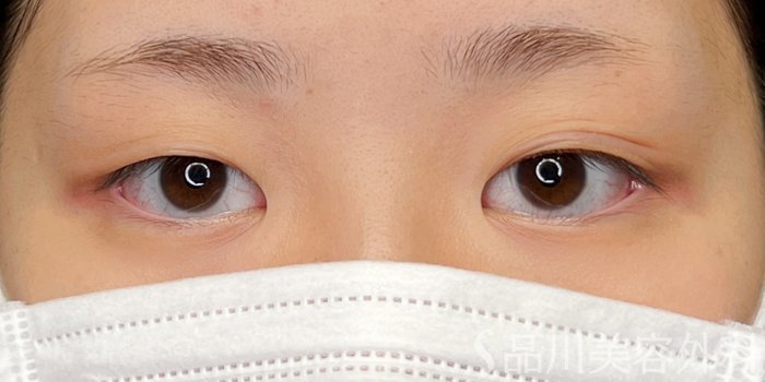 症例NO.73136のBEFORE写真