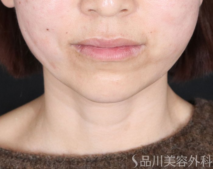 症例NO.72143のAFTER写真