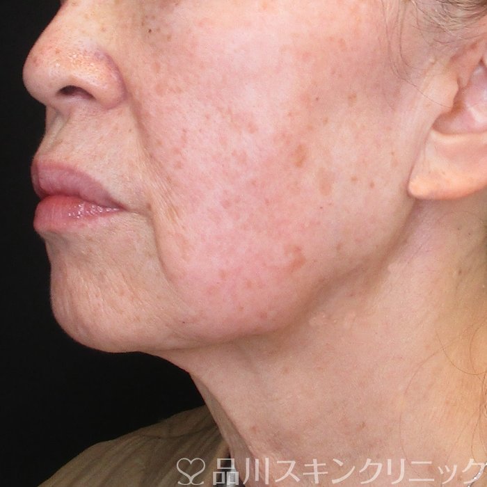 症例NO.72843のBEFORE写真