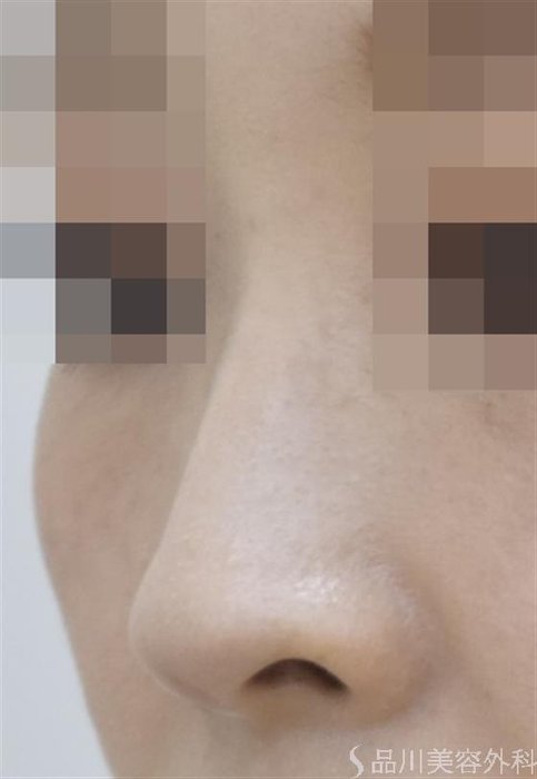 症例NO.47265のBEFORE写真