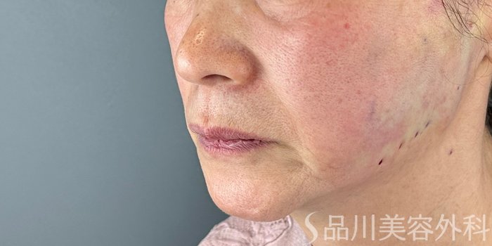 症例NO.72447のAFTER写真