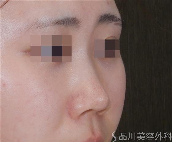 症例NO.60038のBEFORE写真