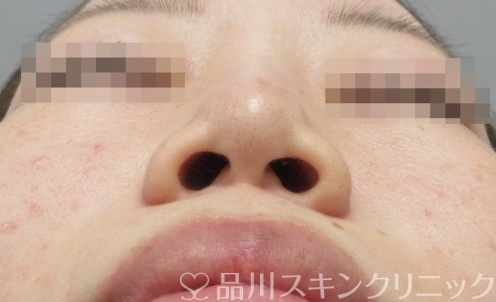 症例NO.71045のBEFORE写真