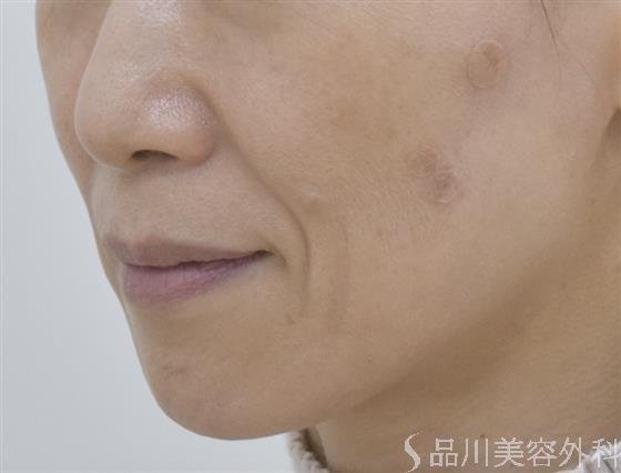 症例NO.51124のBEFORE写真