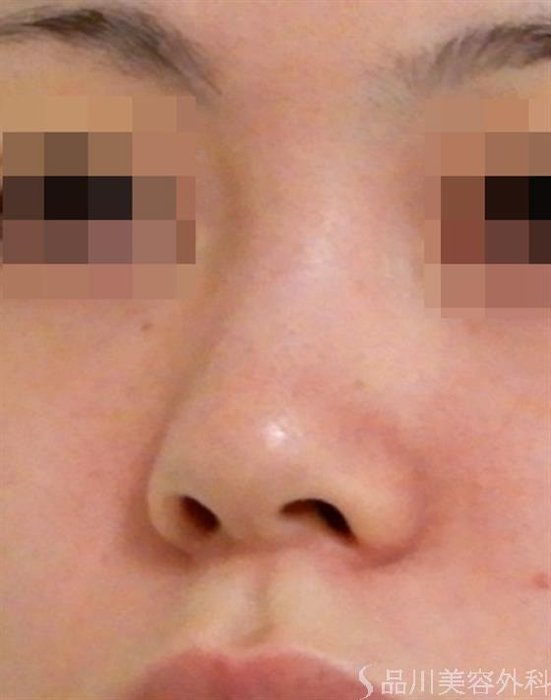 症例NO.38736のBEFORE写真