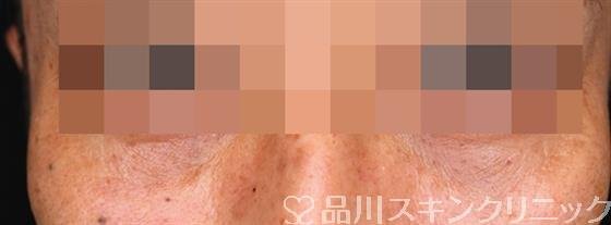 症例NO.52405のAFTER写真