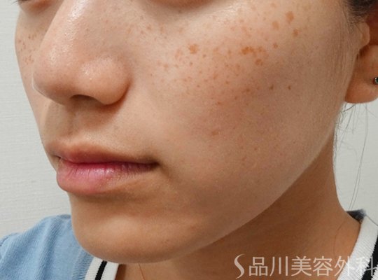 症例NO.68022のBEFORE写真