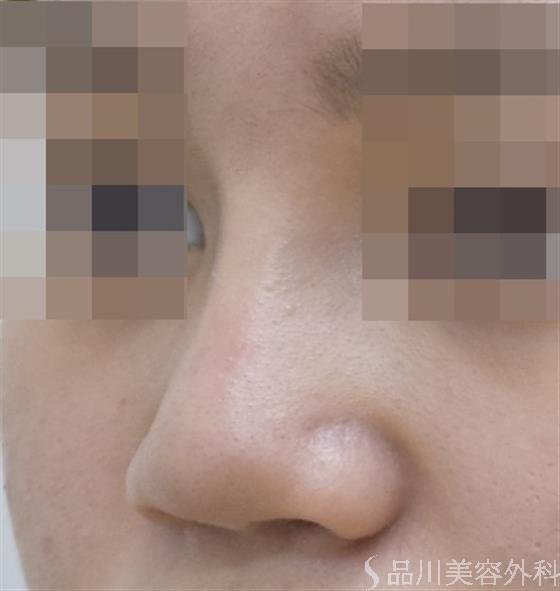 症例NO.46180のAFTER写真