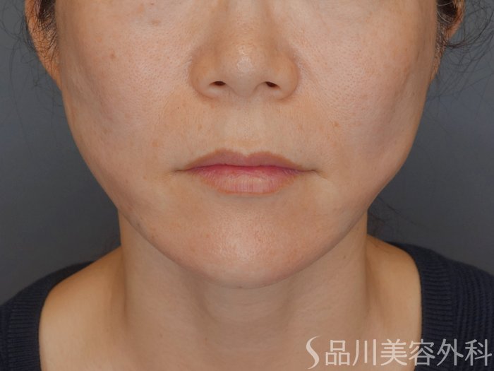 症例NO.72196のAFTER写真