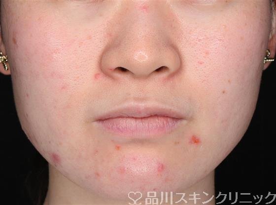 症例NO.59864のBEFORE写真