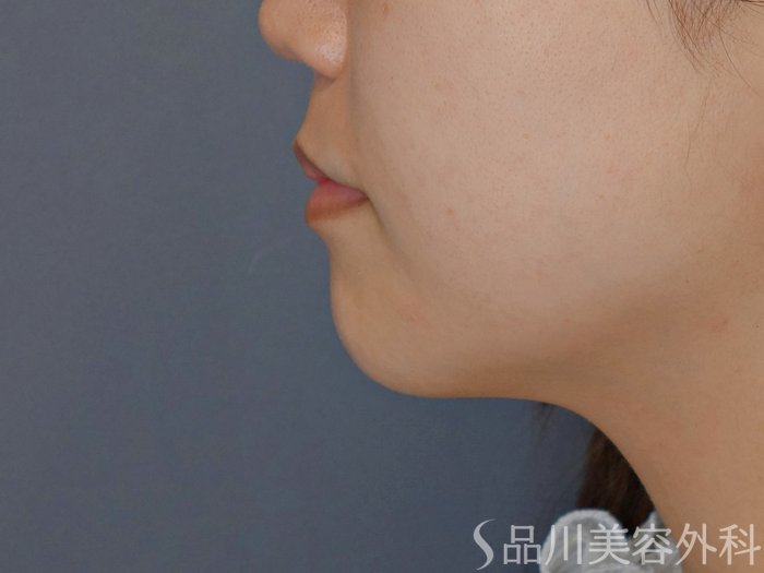 症例NO.71697のBEFORE写真