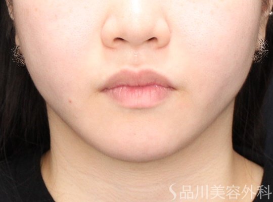症例NO.70961のAFTER写真