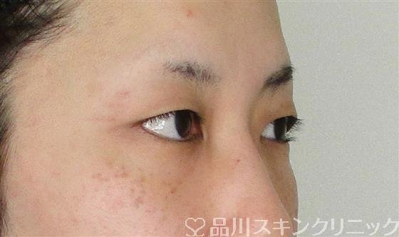 症例NO.61869のBEFORE写真