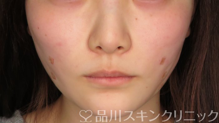 症例NO.71092のAFTER写真