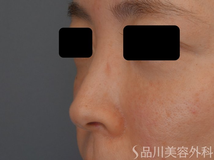 症例NO.69639のBEFORE写真