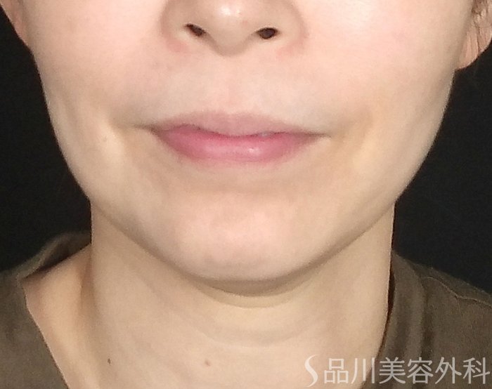 症例NO.70562のBEFORE写真