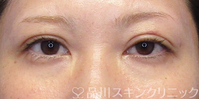 症例NO.75023のAFTER写真